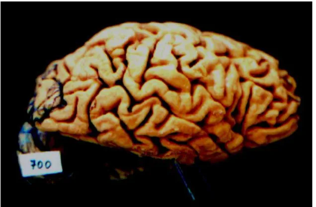 Fig 4.  A macroscopical view of the right side of the brain showing a mild atrophy of the posterior temporal lobe.