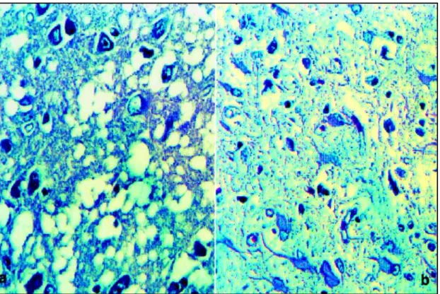 Fig 5 a,b. Severe neuronal loss with status spongiosus in cortical structures (HE 400 X)