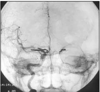 Fig 2. Postoperative angiogram (AP) showing clips occluding aneurysms on the left PComA, right ICA and MCA, through an unilateral craniotomy.