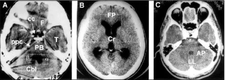 Fig 1. A. Structures which should be present to perform measures of AP and LL : frontal lobes (F), temporal lobes (T), pre-pons (ppc) and/