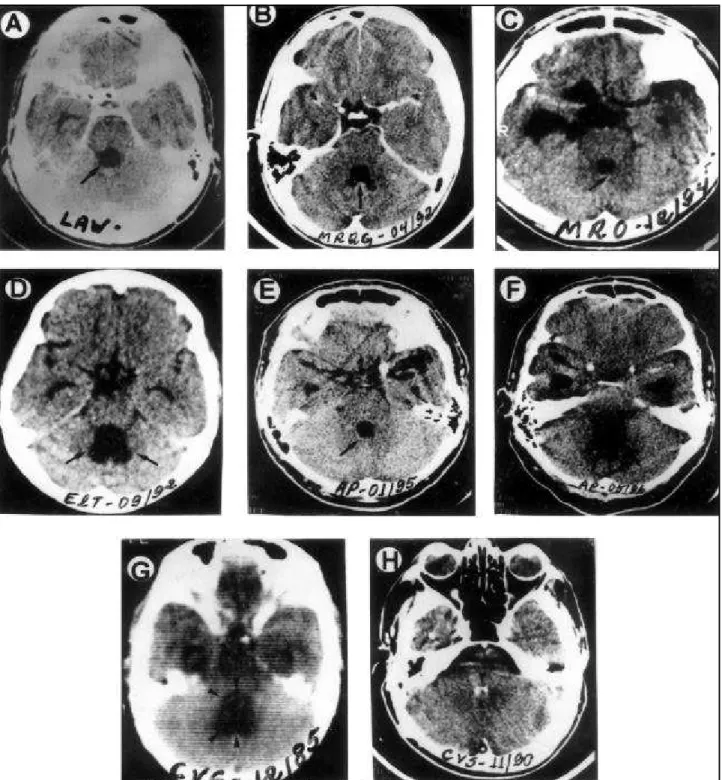 Fig 2.  A and  B. CT of patients with good evolution showing round aspect IV th v (A) or like “coconut hat” (B)