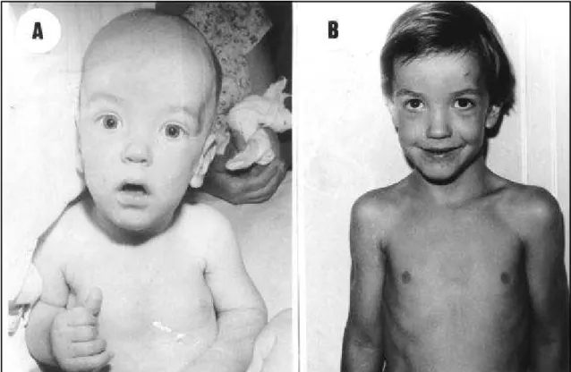 Fig 1. A) Patient 7 at age 6 months with appearance considered typical of Sotos syndrome