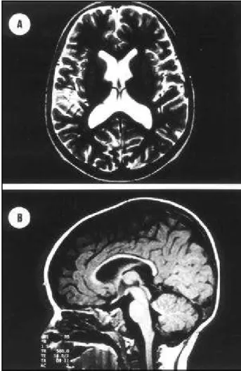 Fig 3. A) T1 weighted axial MRI image of patient 2 showing large global lateral ventricles