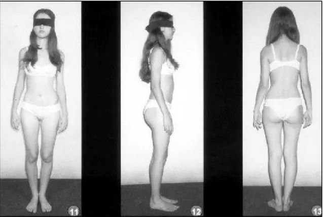 Fig 3. (11), (12), (13) Patient’s anterior, lateral and posterior view  one month after surgery, show ing almost total postural recovery.