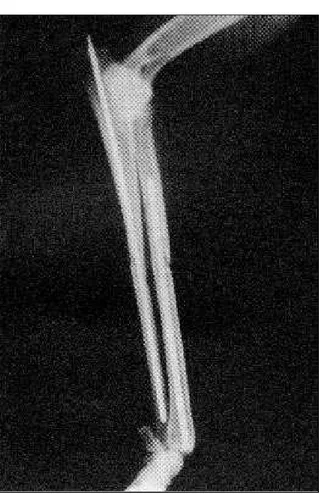 Figura 4 - Radiografia ilustrando a forma de colocação dos pinos intramedulares na estabilização das fraturas diafisárias de rádio e ulna (Grupo II).