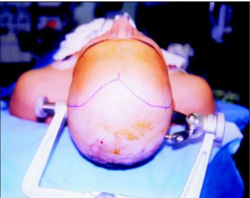 Fig 1. Case 4. Surgical view of the marked line to be incisioned.