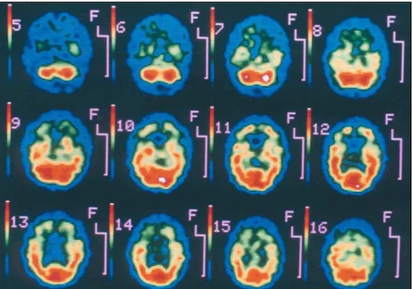 Fig 2. Brain SPECT show ing hypoperf usion in t he f ront al cort ex, caudat e and t halamus.
