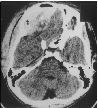 Fig 1. Right  f ront al epidural hemat oma and int racranial air.