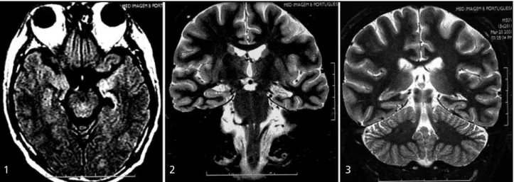 Fig  4. Coronal STIR T2WI - Hyper intensity and abnormal rotation of the left hippocampus (arrow), characterized by atypical aspect of the temporal horn of the left lateral ventricle (thin arrow) and by vertical adjacent collateral sulcus (arrowhead).