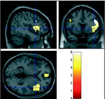 Fig 1. SPM T-statistics images (saggital, coronal and axial slices) of brain regional electric activity for slow frequency band (delta and theta), comparing 25 chronic medicated schizophrenics to 40 controls