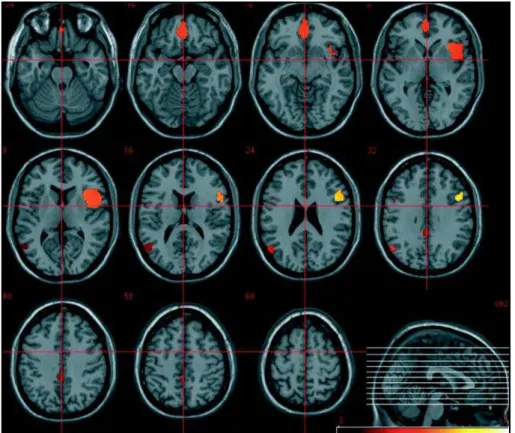 Fig 2. SPM T-statistics axial slices of brain regional electric activity for slow frequency band (delta and theta), comparing 25 chronic medicated schizophrenics to 40 controls