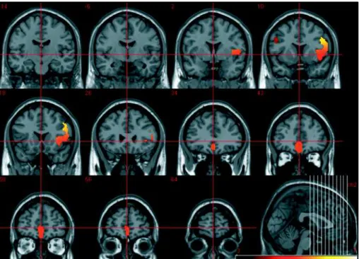 Fig 3. SPM T-statistics coronal slices of brain regional electric activity for slow frequency band (delta and theta), comparing 25 chronic medicated schizophrenics to 40 controls