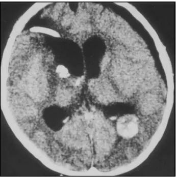 Fig 1. Contrast-enhanced CT scan shows two lesions in ventricular spaces, at right frontal and at left horns, and hydrocephalus.