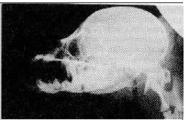 Figura 2 - Radiografia mostrando foco de fratura no ramo da mandíbula, cinco semanas após a ocorrência da  fra-tura