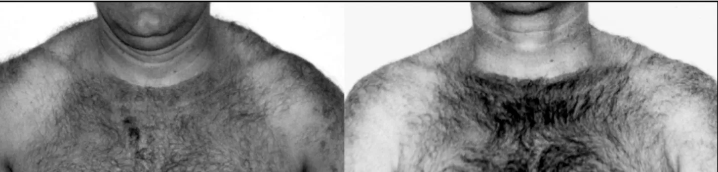 Fig 1. Before and after treatment showing the resolution of pseudohypertrophy.