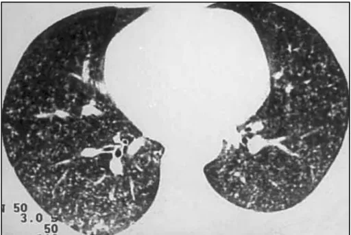 Fig 1. Chest CT scan revealing multiple micronodules at the lung parenchyma, compatible with miliary tuberculosis.