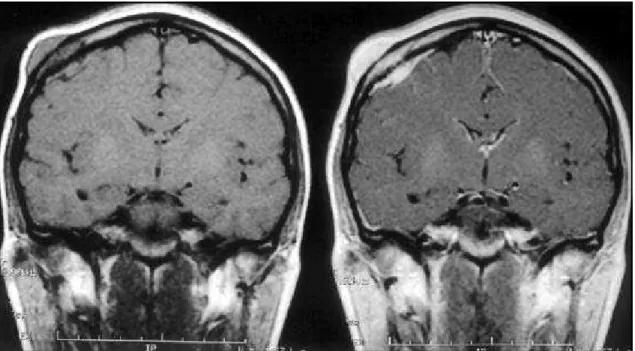 Fig 20. MRI - axial T2WI and axial T1WI post-Gd-DTPA: right temporal-occipital-parietal bone metastasis from colonic carcinoma.