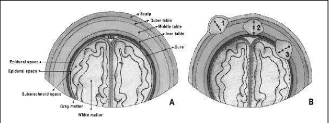 Fig 1. A. Anatomic diagram of the calvaria in coronal section. B. Lesions may arise from these sites; 1 (scalp or outer table); 2 (outer, middle, or inner table); 3 (inner table, extra-axial spaces, or cerebral cortex).