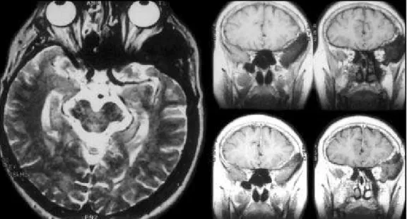 Fig 13. MRI - axial T2WI and  coronal T1WI pre and post-Gd-DTPA: left frontal bone “en plaque” meningioma.