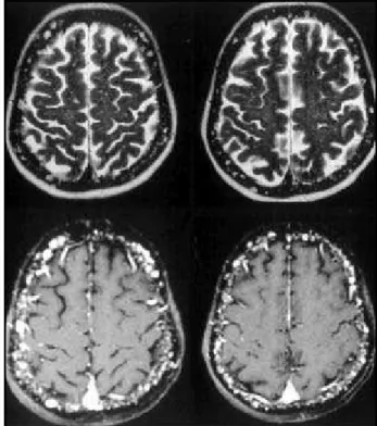 Fig 16. MRI - axial T2WI and axial T1WI post-Gd-DTPA: multiple myeloma.