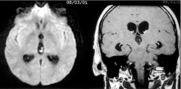 Fig 1. MRI - Axial Diffusion and Coronal T1WI 3mm thick slices postcontrast (Gd-DTPA): Cysticercus in the third ventricle.
