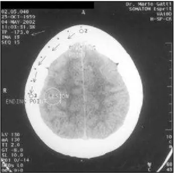 Fig 1. Phantom case. On this scout view the lesion is 79.5 mm above the OM plane. This distance is the difference between the
