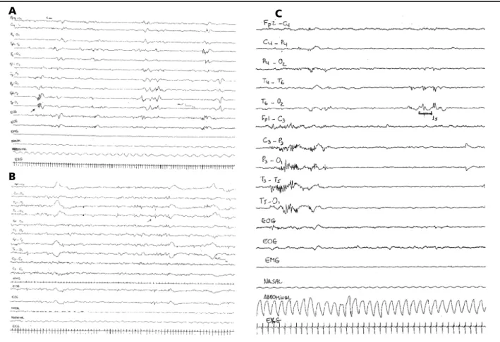 Fig 1. Examples of the different morphologycal features of TST, all EEGs were recorded with speed 15mm/s