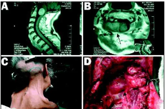 Fig 1. T1-weighted gadolinium-enhanced MRI (A- sagital view, and B- axial view) reveals a mass lesion extending from the craniocervical junction to the vertebral artery
