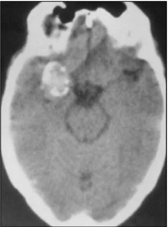 Fig 2. Contrast-enhanced axial CT demonstrating large right tem- tem-poral mass.