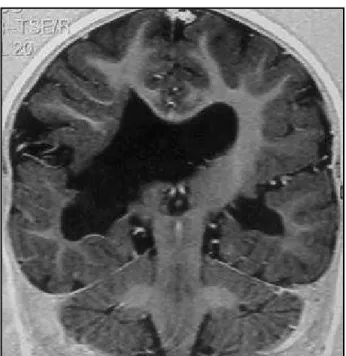 Fig 3. Coronal T1 weighted MRI demonstrating an area of cortical dysplasia at the right temporo-parietal region.