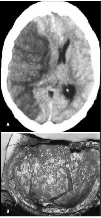 Fig 1. A) Brain computerised tomography at admission: there is marked deviation of midline structures (over 12 mm) caused by an extensive middle cerebral artery infarct