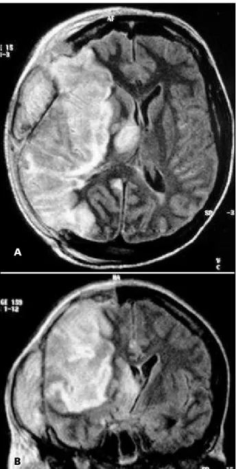 Fig 2. Magnetic resonance in the first post-operative day: