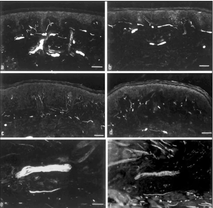 Figs a-f: NGFr immunoreactive fibers in a reactional (a) and in a post-reactional biopsy (b)