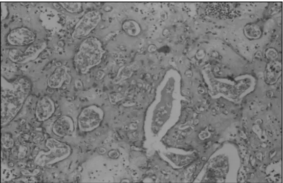 Fig 3. High magnification showing large stromal cells with hyperchromatic nuclei and abundant capillary channels ( HE, 200X).