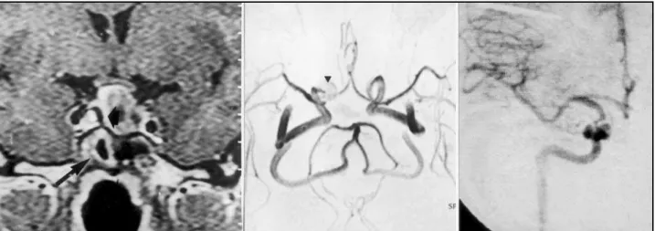 Fig 2. A. Helical Angio-CT showing the stent at the level of the cavernous ICA in the coronal section