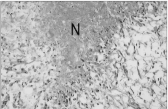 Fig 3. Histological section showing a tumor composed of anaplastic glial cells with mitosis and extensive area of necrosis (N) (HEx40).