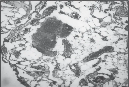 Fig 4. Photomicrograph of a tumor section showing the characteristic angiolipoma pattern with mature adipose tissue intersected by blood vessels (H&amp;E,  X 100).