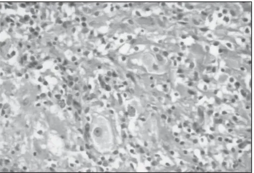 Fig 3. Histopathological examination compatible with conventional gangliocytoma, showing diffuse proliferation of mature-looking nerve cells in a disorganized pattern