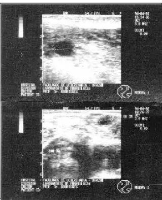 Figura 3 – Imagens ecográficas do folículo ovulatório medido no seu maior diâmetro (cm) do início do estro até a ovulação, numa búfala testemunha (búfala nº 12, ovário esquerdo).