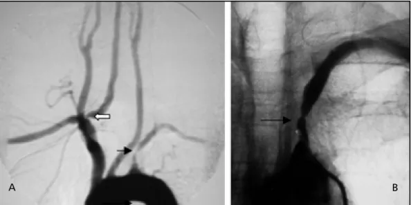 Fig  1. Angiography showed severe stenosis (80%) of the proximal left SA (black arrow) and mild stenosis (40%) at the origin of the right VA (white arrow).