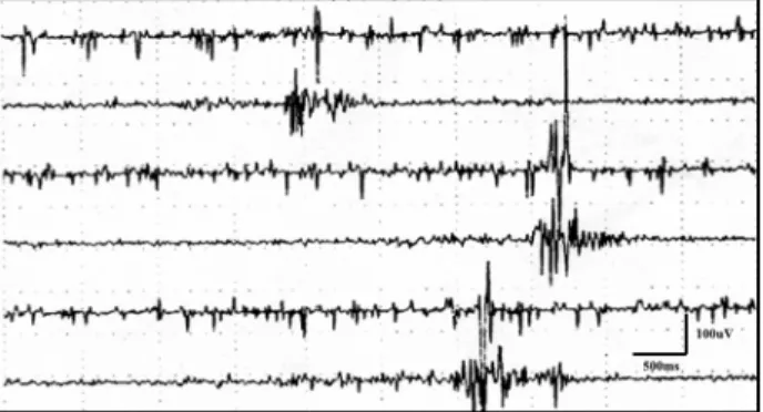 Fig 2. EMG registered in the same muscles described in Figure 1 (A, C, E – right; B, D, F – left), two weeks after Botulinum toxin A.