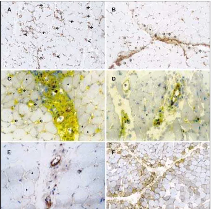 Fig 2. Immunohist ochemical t ransverse 4µ f rozen sect ions f rom M CTD pat ient s prepared by St rept ABCComplex t echnique (in brow n) f or M CH-I (A), M HC-II (B), ICAM -1 (C), VCAM -1 (D), C5b-9 (E), and in a DM  case f or M HC-II (F) (300x)