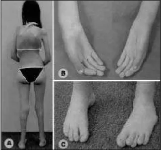 Fig 1. Case 2. Recent  pict ure show ing dif f use muscle hypot ro- ro-phy and kyphoscoliosis (a); abnormal hands(b) and f eet  (c).