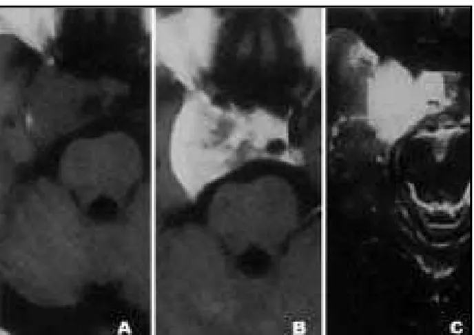 Fig 2. Patient 2. Right para-sellar and supra-sellar lesion iso/hypo- iso/hypo-int ense in T1-w eight ed image (1A), bright ly enhancing af t er gadolinium infusion (1B and 1D) and hyperintense in  T2-weight-ed image (1C)