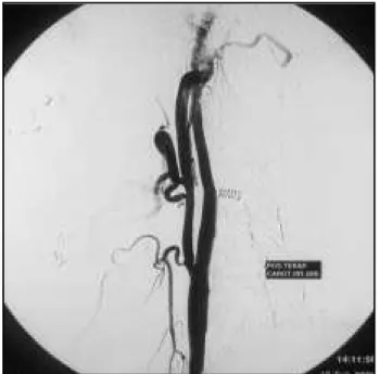 Fig 3. Int ernal cart ot id art ery af t er endovascular t herapy.