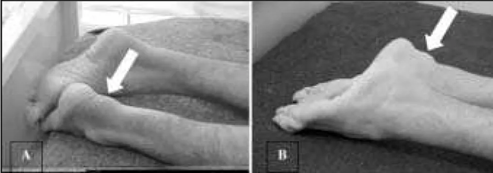 Fig 1. Achilles t endon xant homas (arrow s): case 1 (A) and case 2 (B).