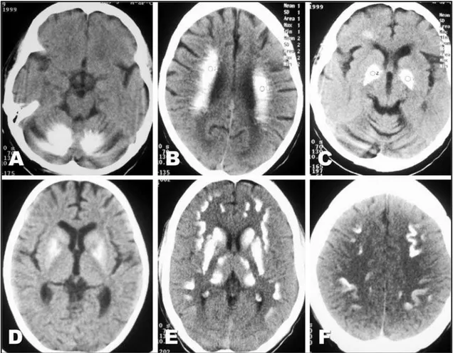 Fig 1. CT axial images show calcifications dentate nucleus and white matter of cerebellum (A), semioval center (B) and globus pallidus (C) in 65 years old with senile dystrophic calcifications