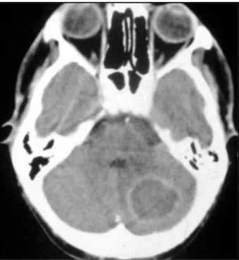Fig 1. Contrast-enhanced computed tomography scan of case 1, showing a large unique ring-enhancing lesion in the left  cere-bellum, sourrounded by discrete edema.