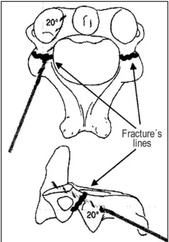 Fig 1. Scheme showing the trajectories and angulations of the drill, avoiding neurovascular lesions.