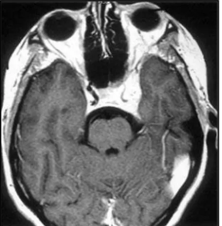 Fig 5. Postoperative CT scan reveals a small superficial cerebellar hemorrhage on the right side.